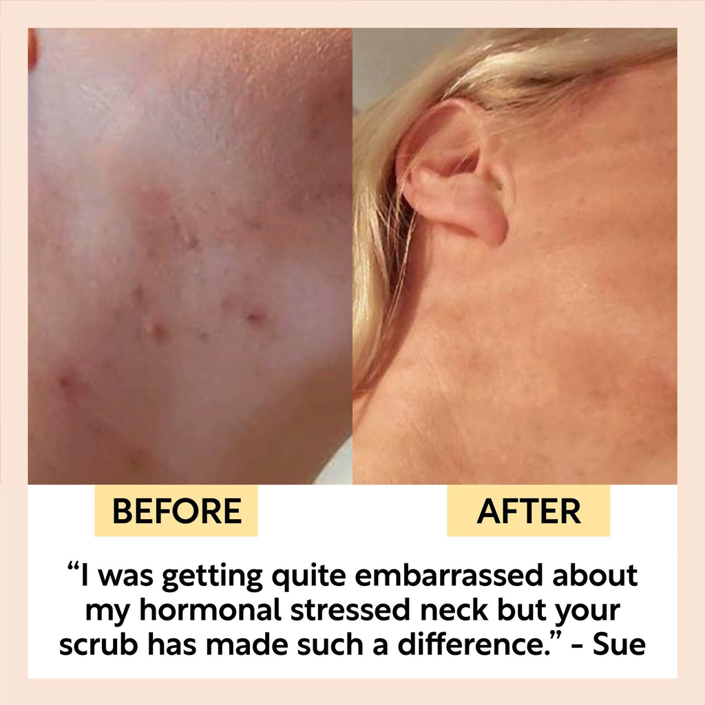 The Acne-Prone Bundle